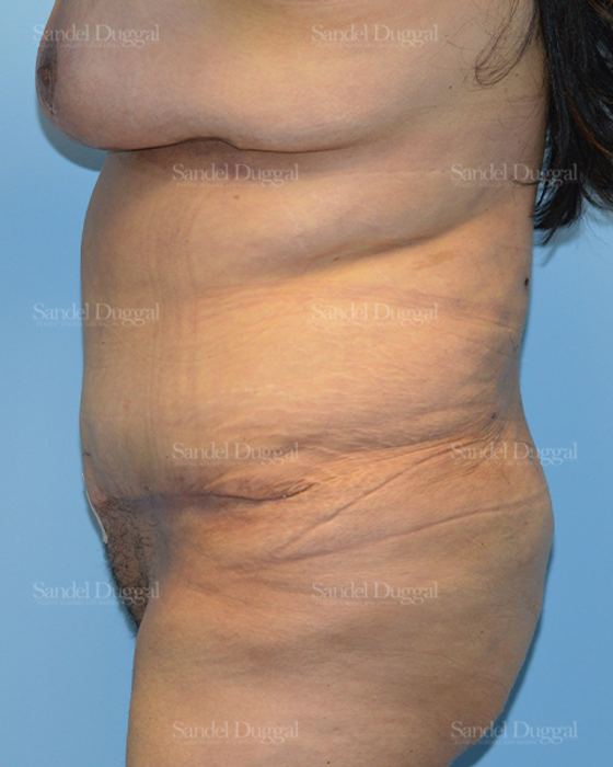 Tummy Tuck after, case 1547