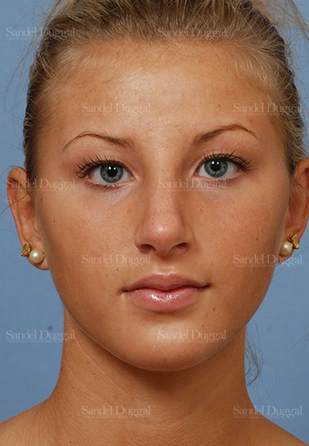 Rhinoplasty after, case 2876