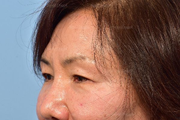 Eyelid Rejuvenation before, case 5318