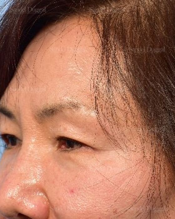 Eyelid Rejuvenation before, case 5318