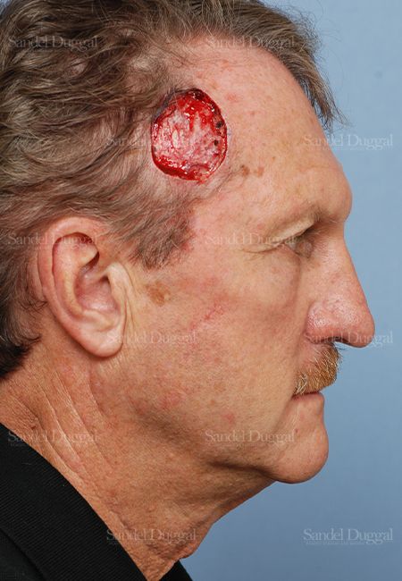 Reconstruction after Mohs before, case 2751