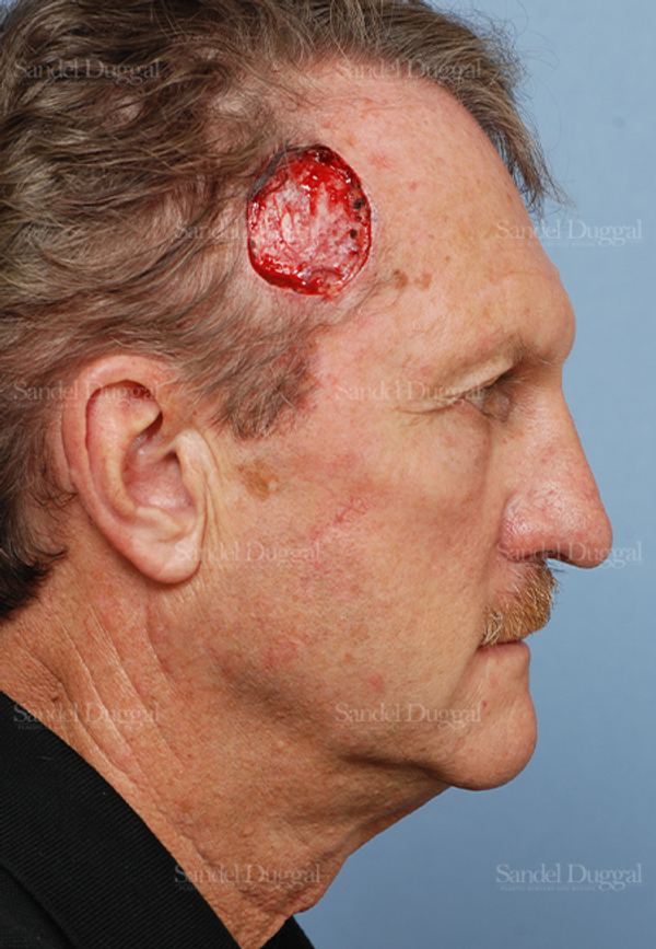 Reconstruction after Mohs before, case 2751