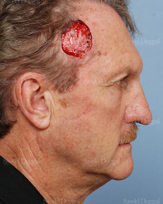 Reconstruction after Mohs before, case 2751