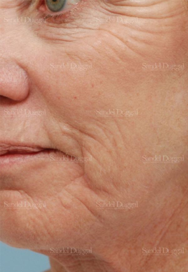 Laser Skin Resurfacing after, case 2941