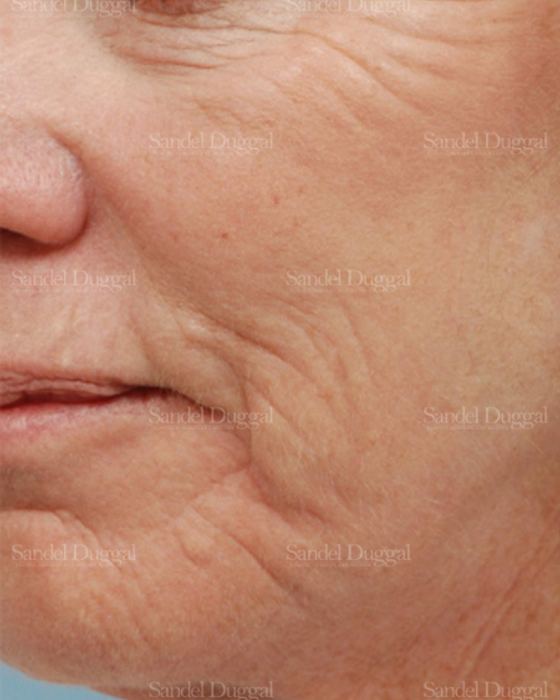 Laser Skin Resurfacing after, case 2941