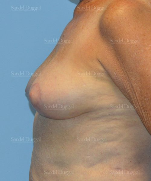 Breast Lift after, case 3315