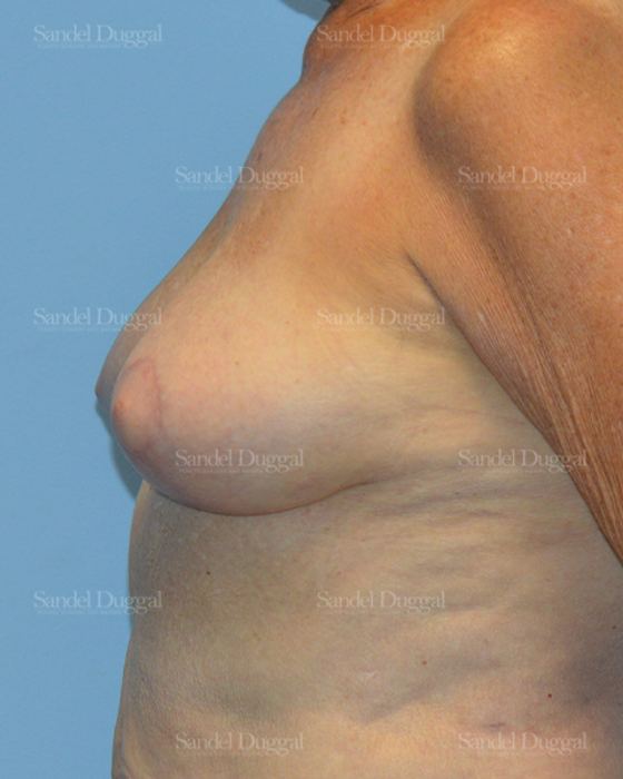 Breast Lift after, case 3315