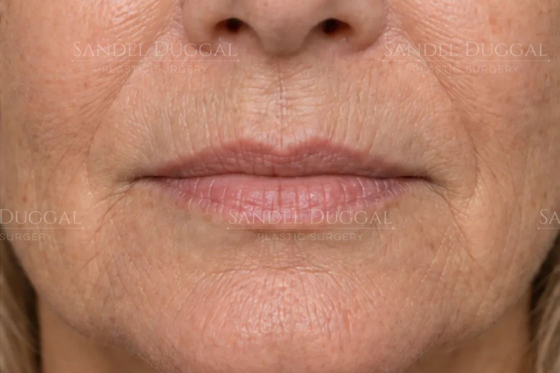 Lip Filler before, case 6015
