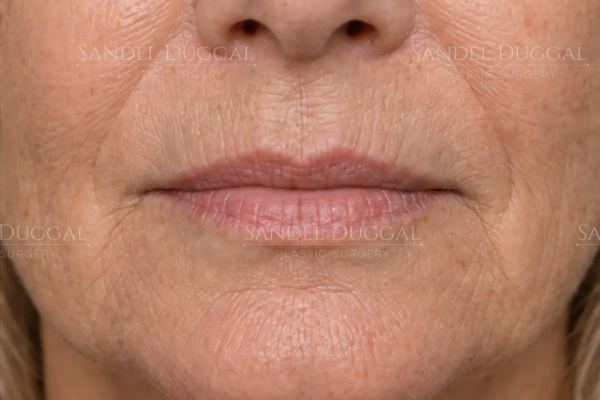 Lip Filler before, case 6015
