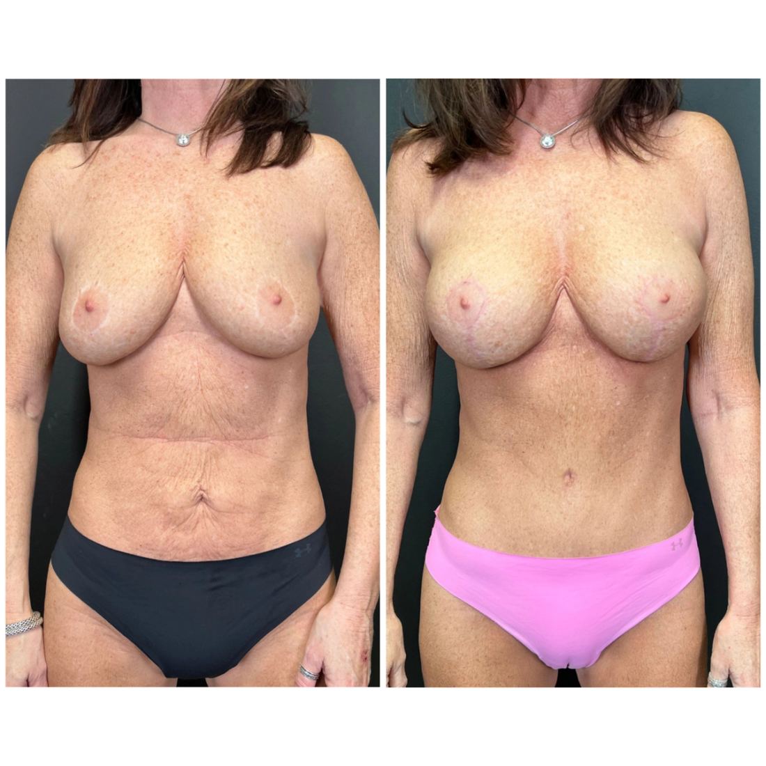 Mommy Makeover before and after, case mommy-makeover-02