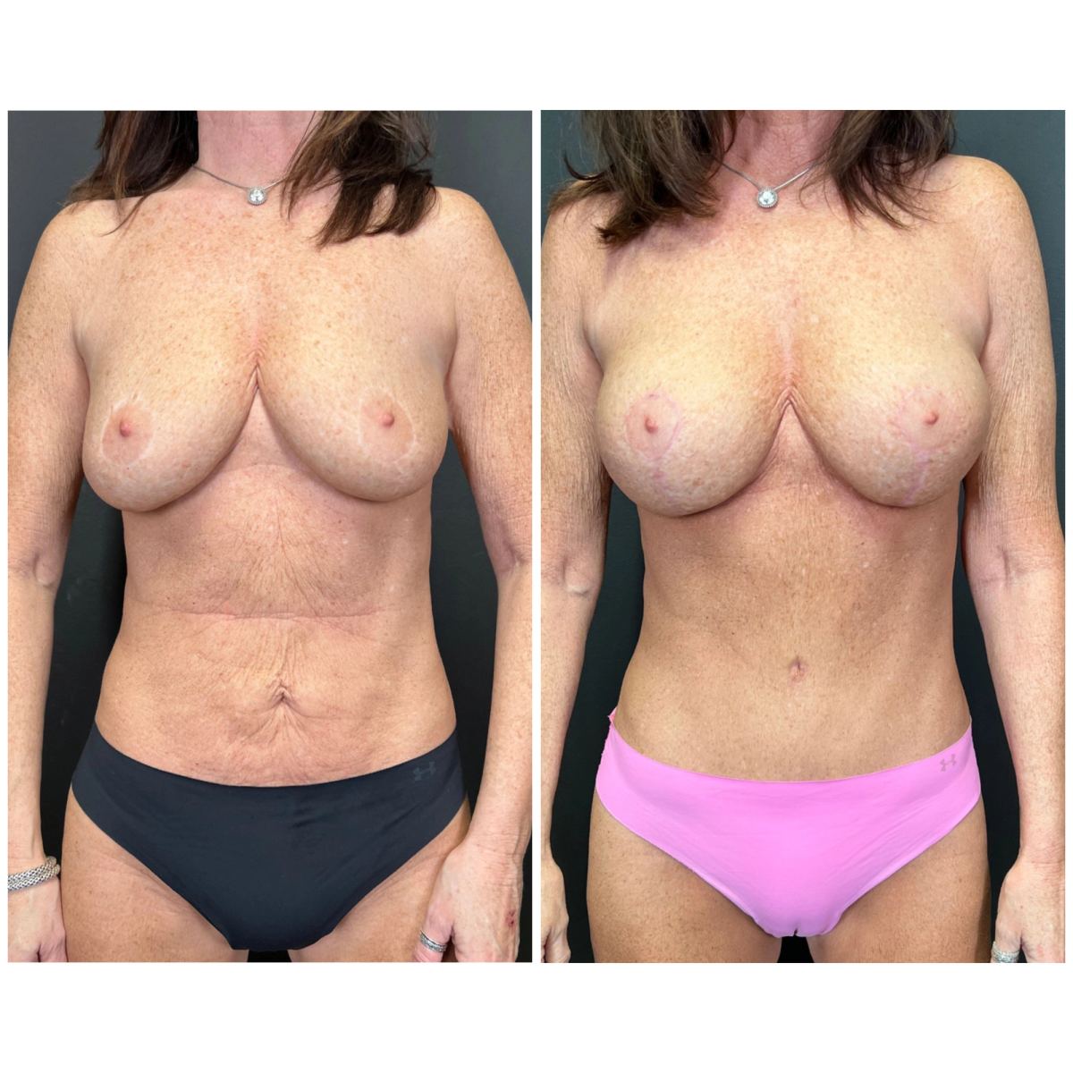 Mommy Makeover before and after