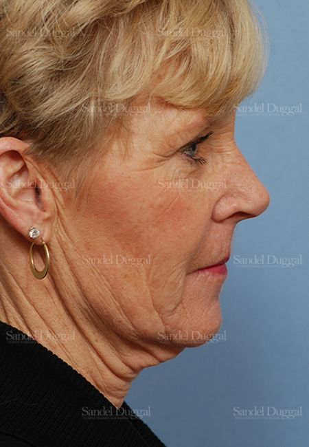 Facelift before, case 2707