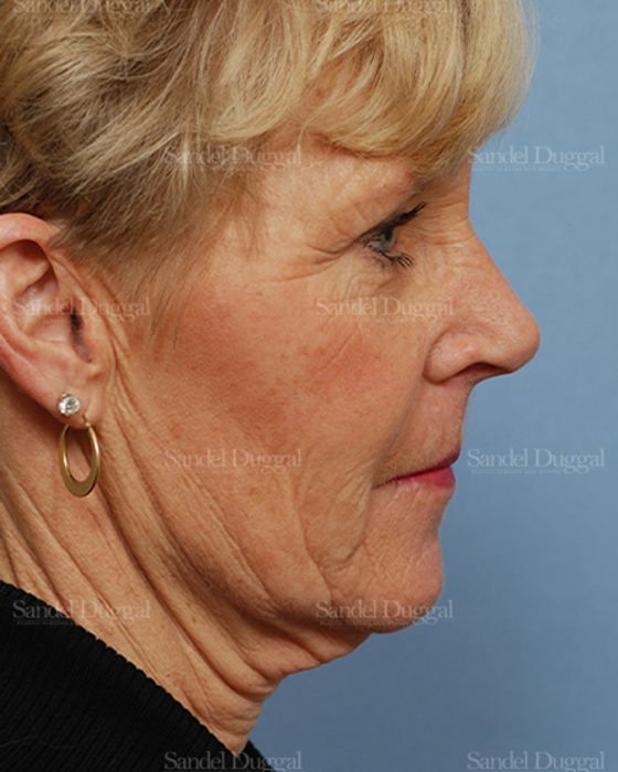 Facelift before, case 2707