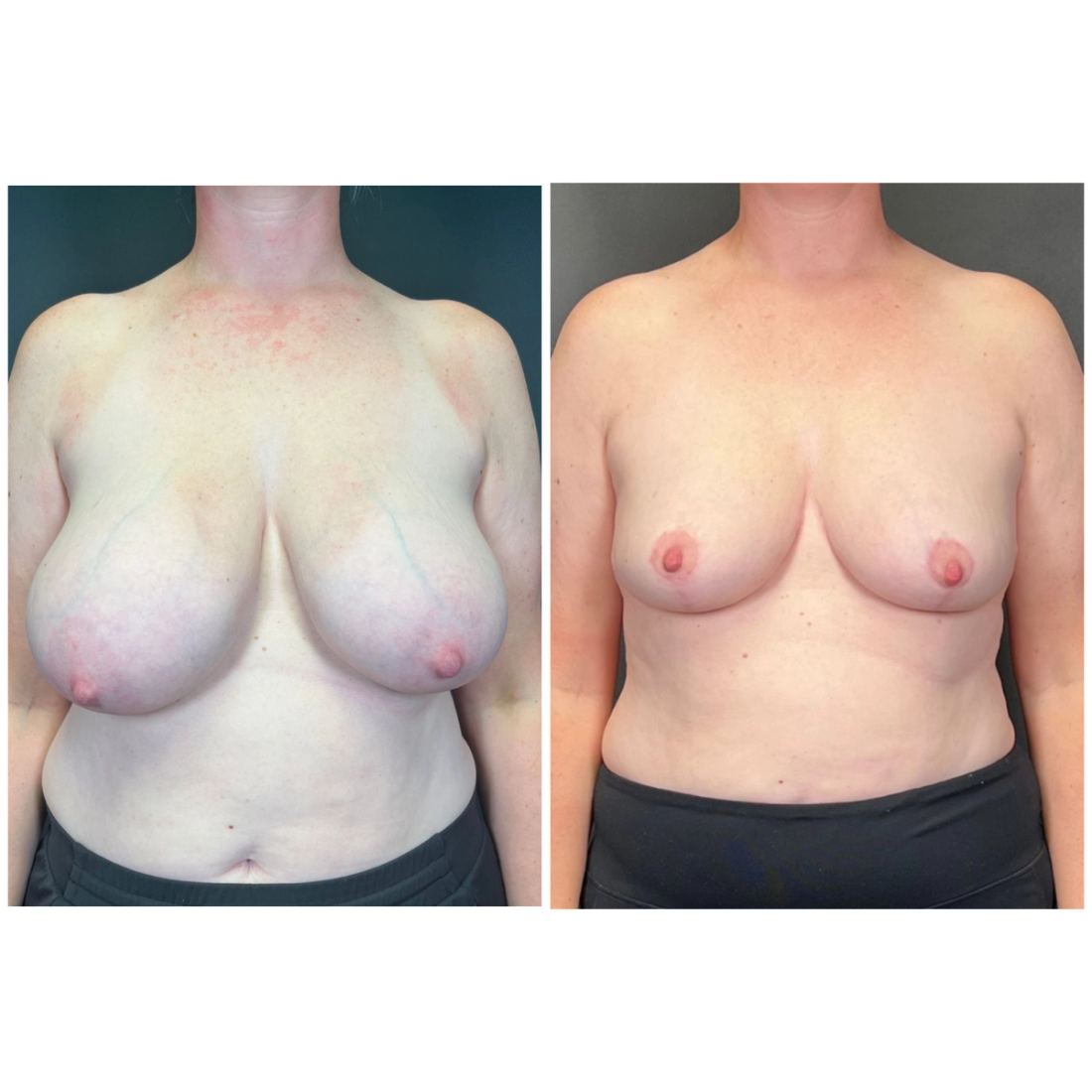 Breast Lift before and after, case breast-lift-new-10