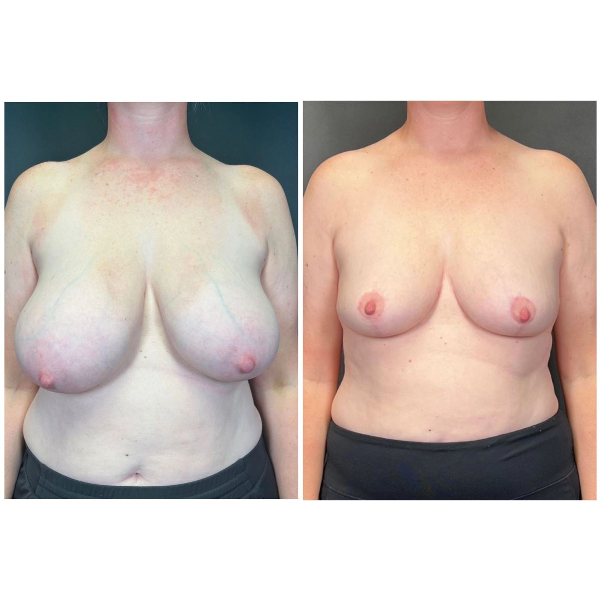 Breast Lift before and after
