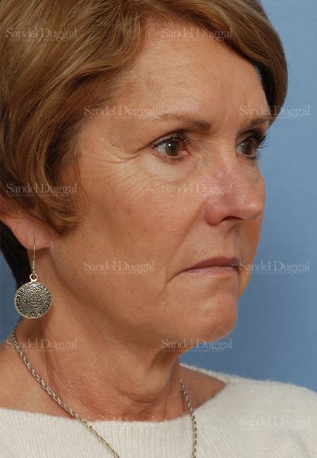 Facelift before, case 2697