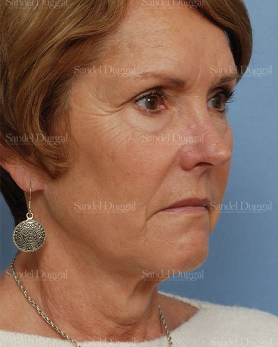 Facelift before, case 2697