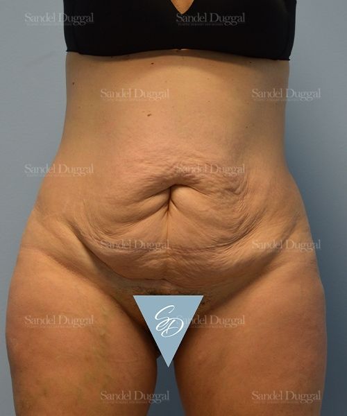 Tummy Tuck before, case 1722