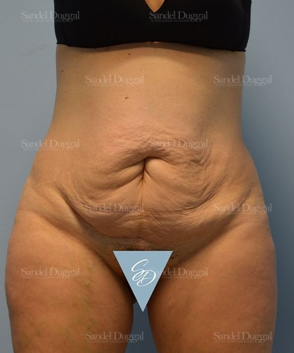 Tummy Tuck before, case 1722