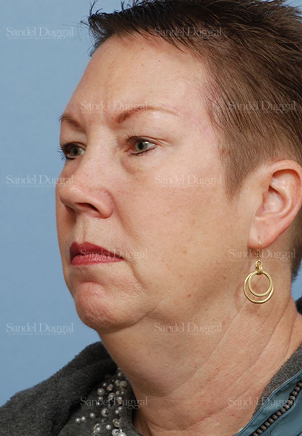 Reconstruction after Mohs after, case 2754