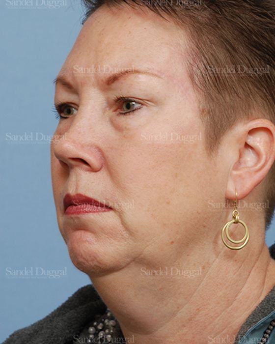 Reconstruction after Mohs after, case 2754