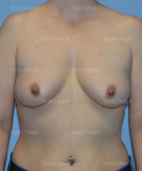 Breast Augmentation before, case 778
