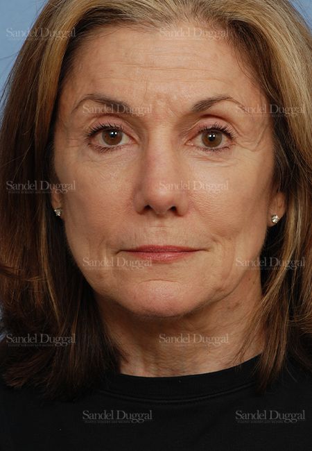 Rhinoplasty after, case 2845