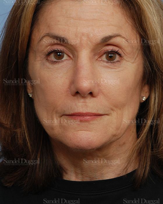 Rhinoplasty after, case 2845