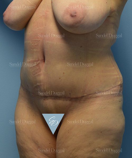 Tummy Tuck after, case 1566