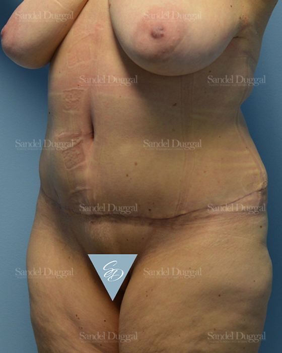 Tummy Tuck after, case 1566