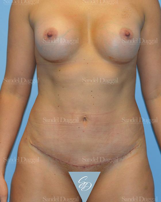 Mommy Makeover after, case 785