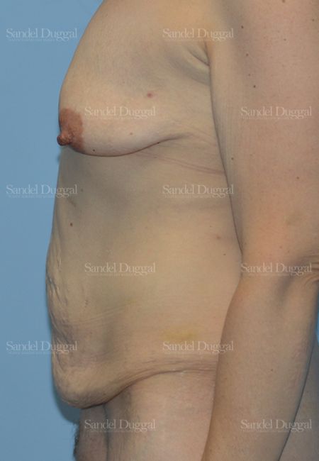 Mommy Makeover before, case 2211