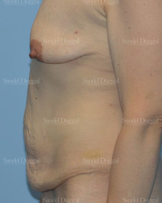 Mommy Makeover before, case 2211
