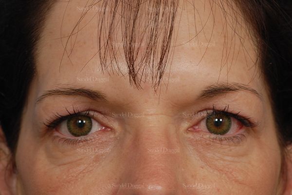 Eyelid Rejuvenation before, case 1960