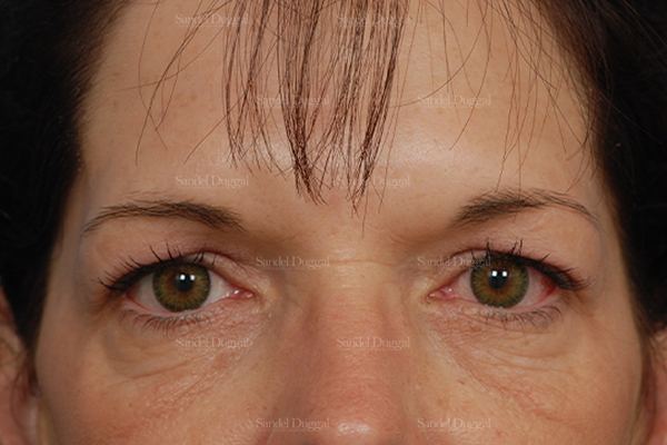 Eyelid Rejuvenation before, case 1960