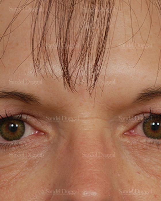 Eyelid Rejuvenation before, case 1960