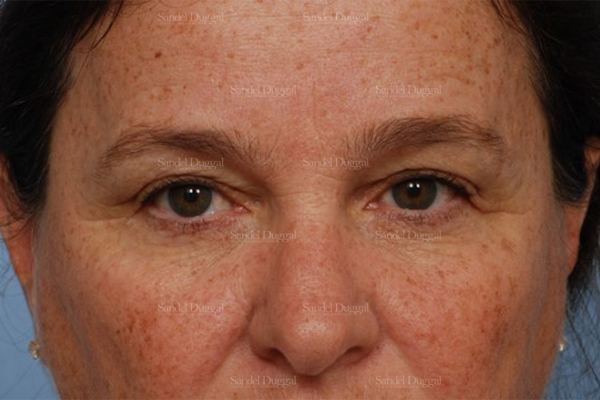 Eyelid Rejuvenation before, case 1980
