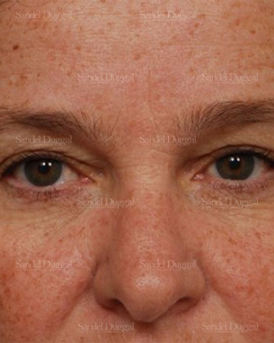 Eyelid Rejuvenation before, case 1980