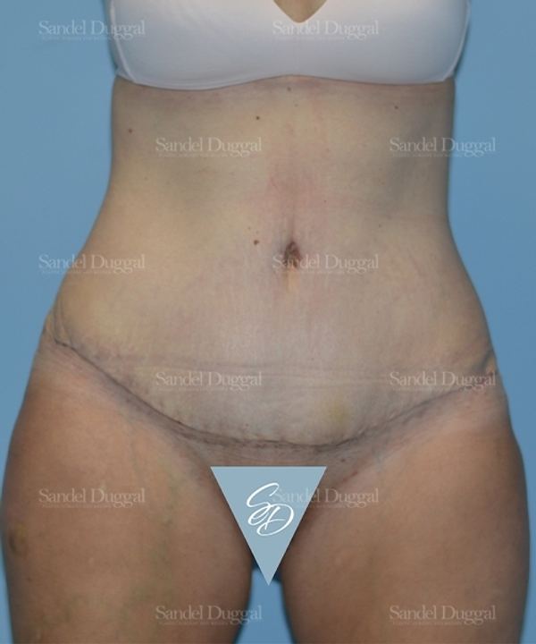 Tummy Tuck after, case 1722