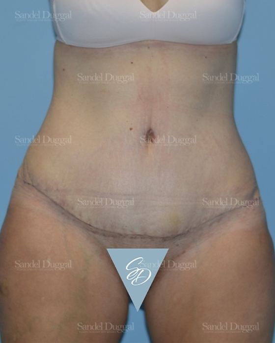 Tummy Tuck after, case 1722