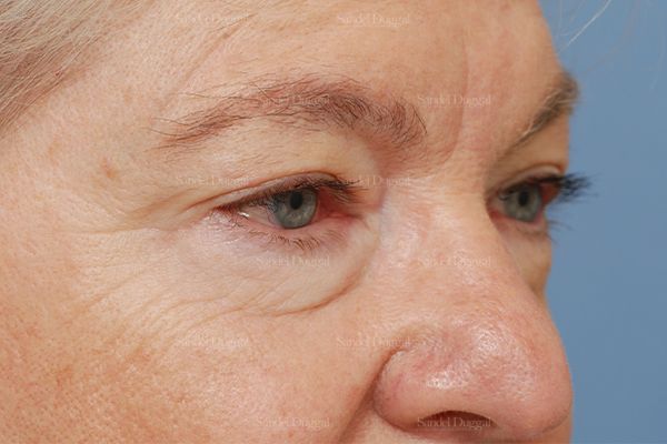 Eyelid Rejuvenation before, case 1927