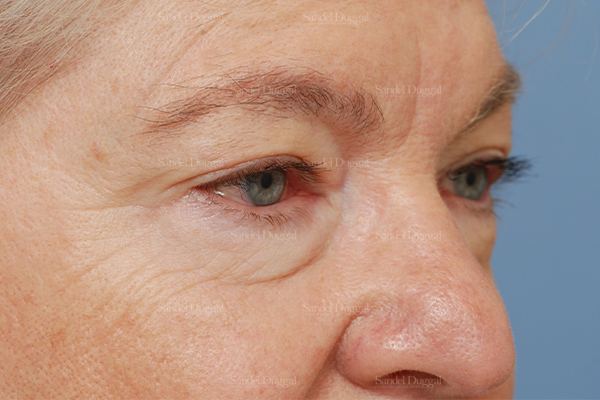 Eyelid Rejuvenation before, case 1927