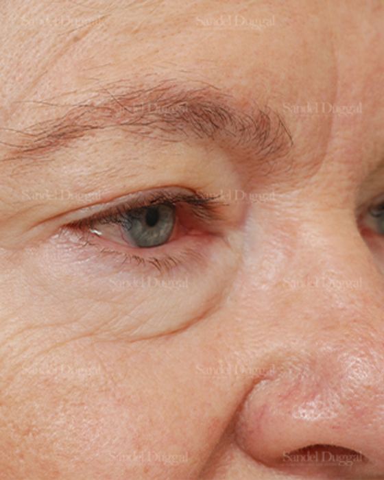 Eyelid Rejuvenation before, case 1927