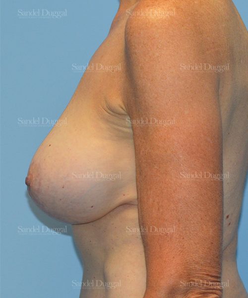 Breast Augmentation with Lift after, case 3372