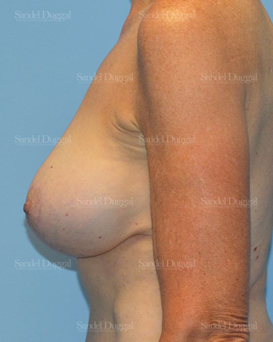 Breast Augmentation with Lift after, case 3372