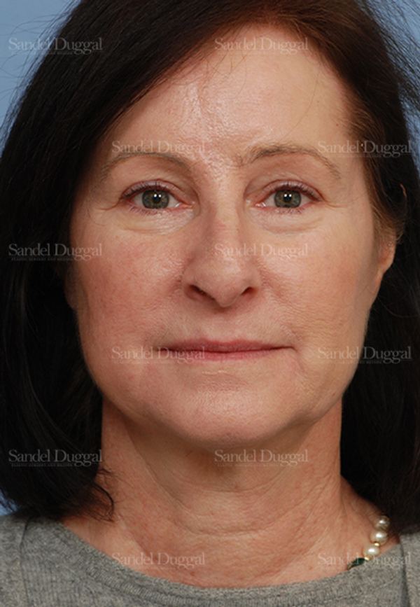 Reconstruction after Mohs after, case 2781