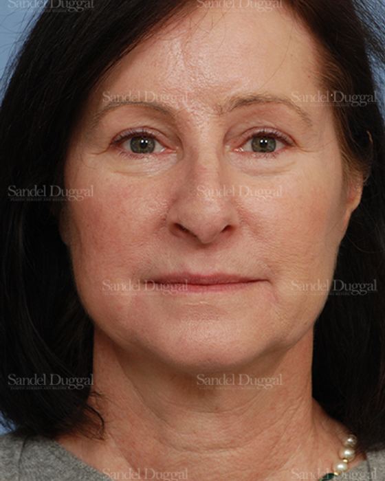 Reconstruction after Mohs after, case 2781