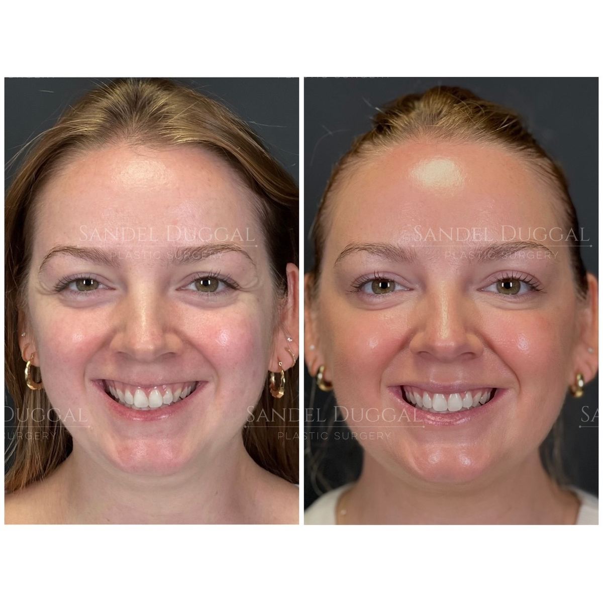 Botox & Fillers before and after, case 6006