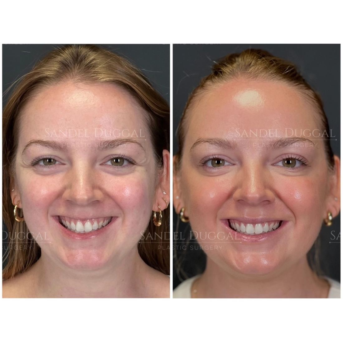 Botox & Fillers before and after, case 6006