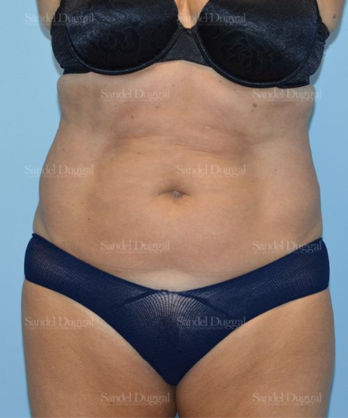 Tummy Tuck before, case 1636